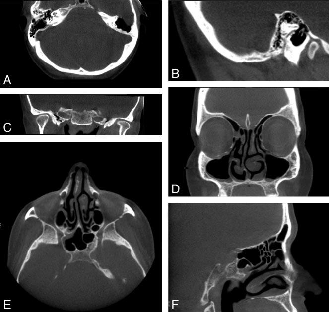 Fig 3. Clinical images of 2 patients acquired with the MiniCAT dedicated head and neck CBCT scanner.