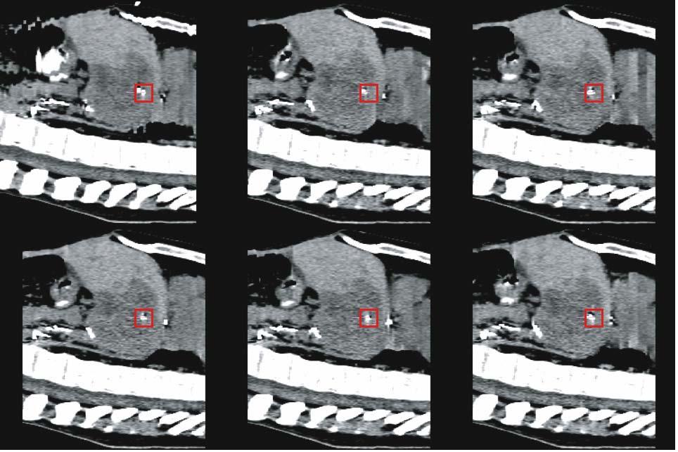 4D Imaging and Treatment Planning 87 Fig. 8.5. Standard helical CT scan acquired under light breathing (left) in comparison with one respiratory phase of a 4D CT scan (right).