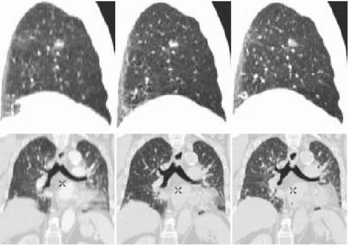 90 E. Rietzel and G.T.Y. Chen a b c Fig. 8.9. Sagittal (a c) and coronal (d f) views of two lung tumor patients. a, d Standard helical CT scans acquired under light breathing. b, e End inspiration.