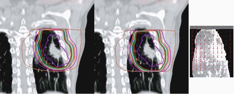 96 E. Rietzel and G.T.Y. Chen Fig. 8.17. Deformation of a dose distribution according to non-rigid CT CT registration parameters to a reference respiratory phase.
