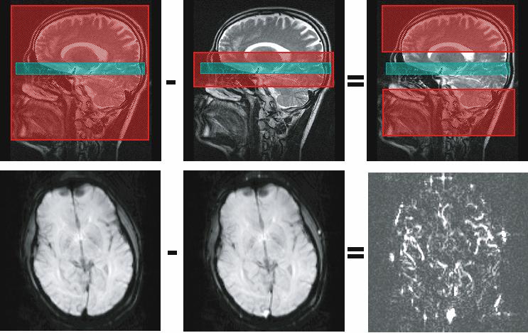 Magnetic Resonance Imaging for Radiotherapy Planning 109 therapy, MRI is used for monitoring the response to treatment and for evaluating radiation-induced side effects.