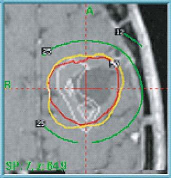Potential of Magnetic Resonance Spectroscopy for Radiotherapy Planning 121 Fig. 10.3. Same case as in Fig. 10.2. Upper row: GK treatment plan for the respective case in axial and sagittal plane.