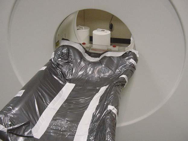 Even with an insert-type couch, the immobilization devices used with a stand-alone PET scanner are limited in size and cannot be wider than approximately 20 in. (Fig. 11.3d).