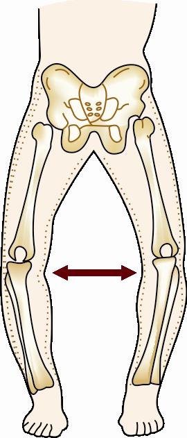 Fig 1: Inward bending of your knees is called the knock knee deformity Presentation This problem is more common in elderly people that too females and is due to degeneration of the
