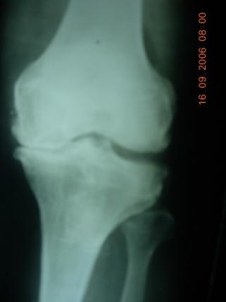 Radiograph Radiograph of the whole limb should be done to assess the severity of genu varum but also helps to know the extent of the diseases of the knee especially osteoarthritis of the knee.