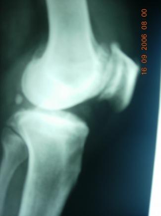 Fig 5: Plain x-rays of the knee helps to know the extent of genu varum and also the disease like osteoarthritis of the knee Treatment Before 4 years of age: Treatment is non-operative (conservative)
