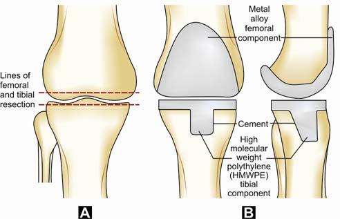 and is done is young individuals Fig 7: In Knee replacement