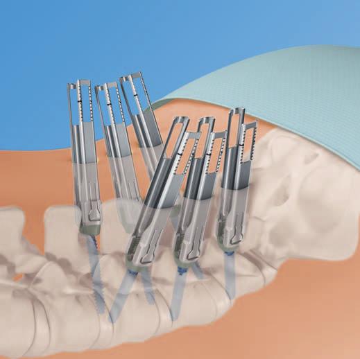 MATRIX Spine System MIS Instrumentation.