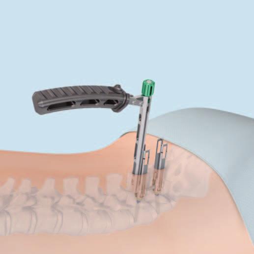 The rod may be inserted from either the cranial or caudal direction. With the rod pointed down, insert the rod through the retraction blades.