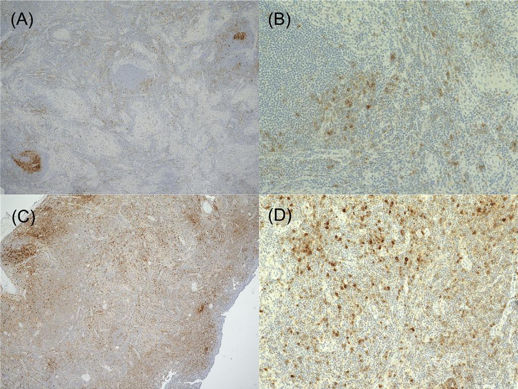 TATARA ET AL. 3 FIGURE 1 Immunohistochemical staining of PD-1 in metastasis-negative SLNs. PD-1 intensity was categorized as described in section 2 (under magnification 40 ).