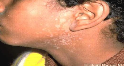 Patches may be white, pink, red or brown and can be lighter or darker than the skin around them; Carboxylic acid, which is produced by the yeast, causes depigmentation, either hypo OR hyper