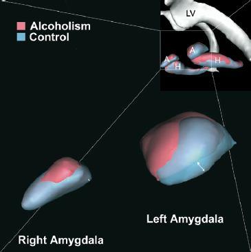 First of all, the amygdala might play an important role in the regulation of alcohol behavior, because dysfunction or lesions of the amygdala causes impulsivity (due to the positive reinforcing