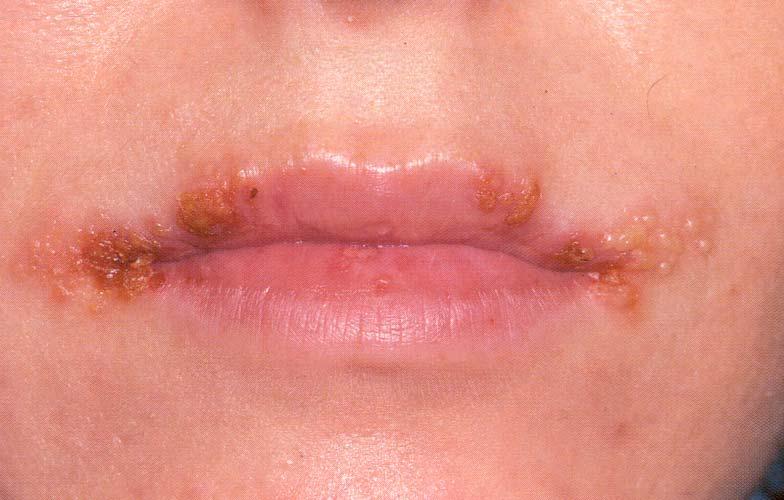 Herpes Simplex Secondary Herpetic Infections The common coldsore or fever blister Precipitated by fever,