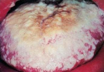 epithelium containing numerous matted mycelia over an erythematous mucosa