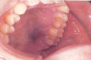 Kaposi s Sarcoma(KS) Oral KS has a variety of clinical presentations Initially oral KS may appear as a small patch Color may