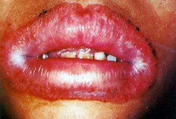 Contact Stomatitis Patients who react