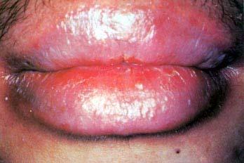 reaction of the oral
