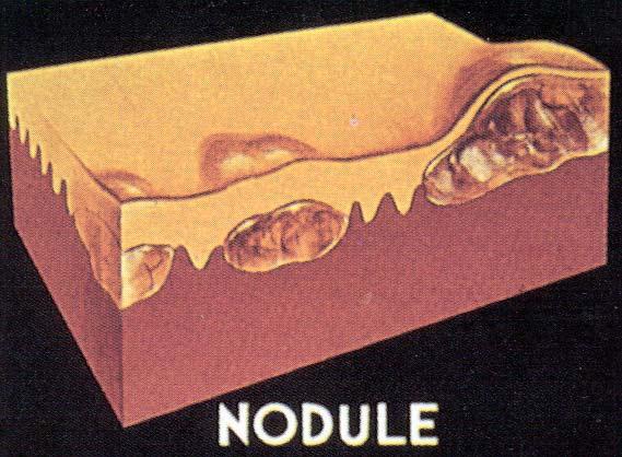 ORAL NODULES Papules that grow become