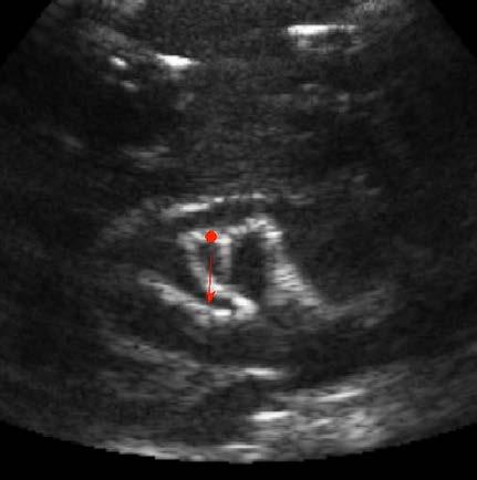 kidney stones using focused ultrasound