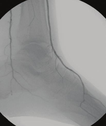 Preprocedural ankle-brachial index was within normal limits on the left side, measuring 1.31.