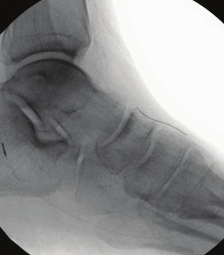 Given the patient s history of contralateral amputation and the focal distribution of his nonhealing ulcer within the lateral plantar angiosome, the decision was made to perform further investigation