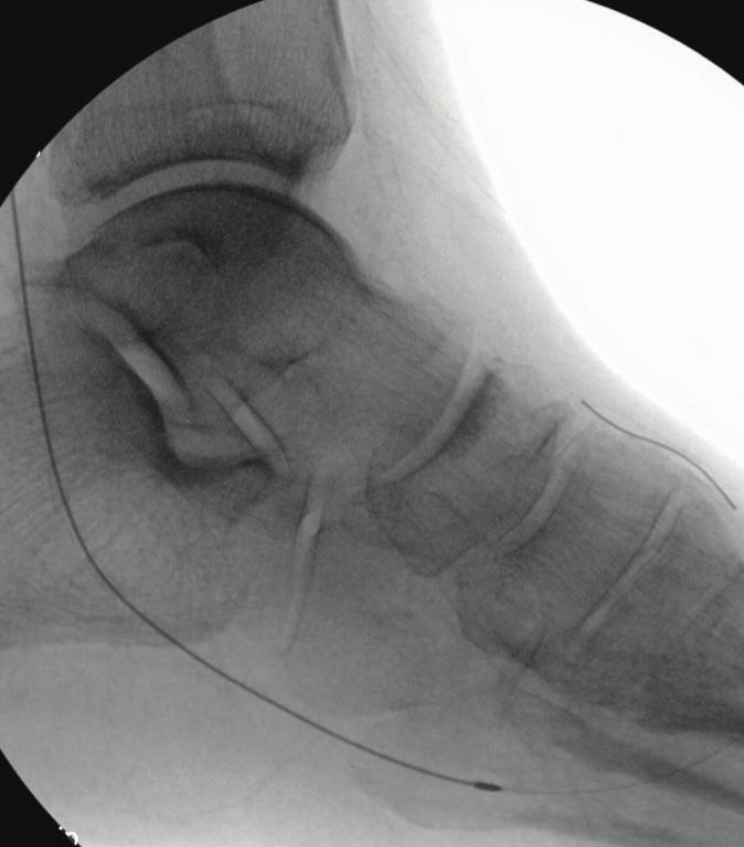 While rotating on the RotaWire (Boston Scientific Corporation), this front-end cutting feature engages the lesion directly without the need for predilatation.