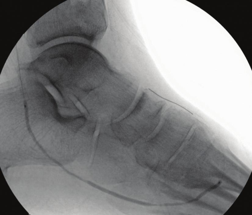 Figure 5 S was performed with a Figure 6 T 1.25-mm burr through the lateral plantar artery, U utilizing the Morse code V technique (Figure 4).