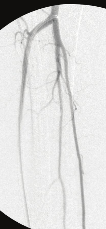 Figure 11 Figure 12 nonpalpable bilateral posterior tibial artery pulses, but monophasic Doppler signals were obtained, and there were palpable bilateral dorsalis pedis artery pulses.