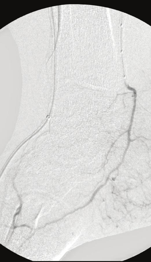 A completion angiogram confirmed these findings with markedly improved velocity of opacification through the posterior tibial artery (Figures 11 and 12).