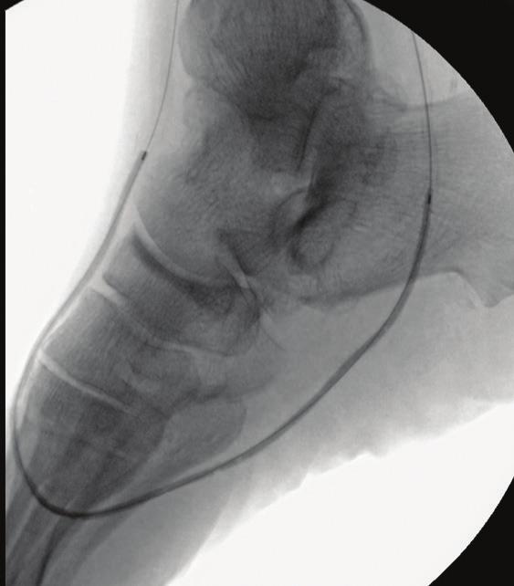where low-dose right lower extremity angiography was performed (Figure 13). Endovascular ultrasound was then performed with a 0.014-inch probe.