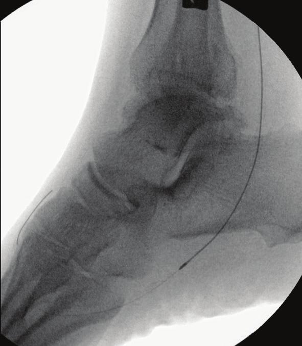 Singlevessel dominant runoff to the foot was provided by the anterior tibial artery, however, the distal dorsalis pedis artery did not opacify (Figure 14).
