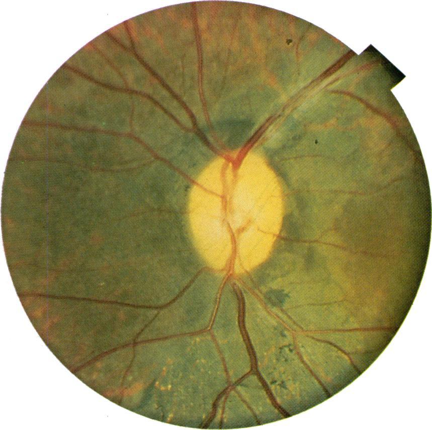 sit.s (arrows below dhi~v). Note study (Fig. 7). A retinal haemorrhage appeared at also intrarettinalpiglentt cluopingsuperonasal to disc.