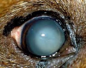 Cataract Posterior