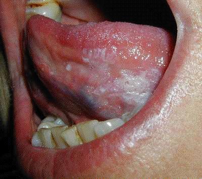 Oral Hairy Leukoplakia By Salvatore Marra, from