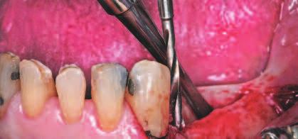 Potential risks include compromised aesthetics and contamination of the newly operated site by provisional restorative materials.