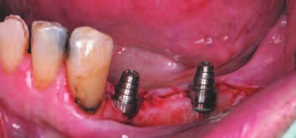 Implant Stability Quotient (ISQ) readings indicated a high level of initial implant