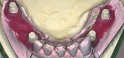 8 Provisionalization An occlusal registration was made with