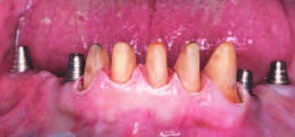 filled with chlorhexidine gel, and the provisional restorations were