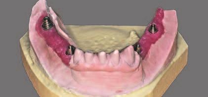 Occlusal equilibration was done, and the patient was instructed in