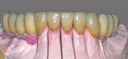 Prostheses along with the all-ceramic restorations for the natural dentition were placed