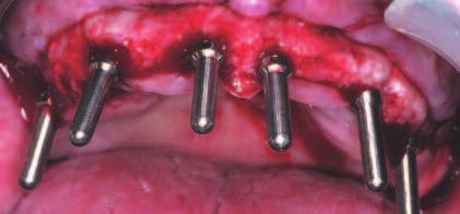 with implant therapy in the maxillary arch.