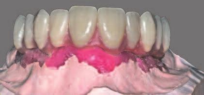 make an occlusal registration by filling the template with polyvinylsiloxane occlusal