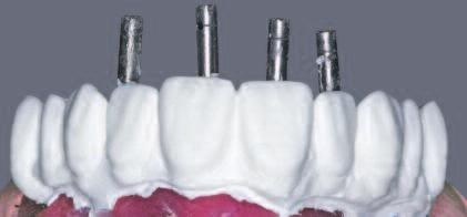 With this technique, information about the interocclusal height, midline, shape of the teeth,