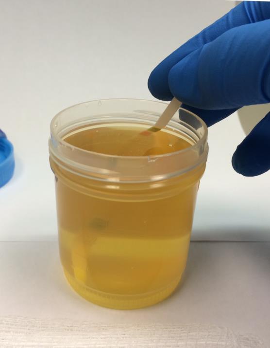 Patient Testing Procedure Dip the test strip into the urine no