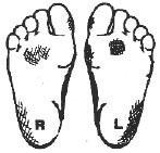 O TOE POSITIONS: (NON-WEIGHT BEARING) Contracted Straight HAV Morton
