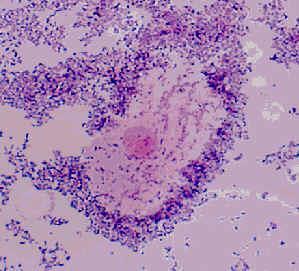 Bacterial Vaginosis Clinical Features- 47-50% asymptomatic Malodorous, thin