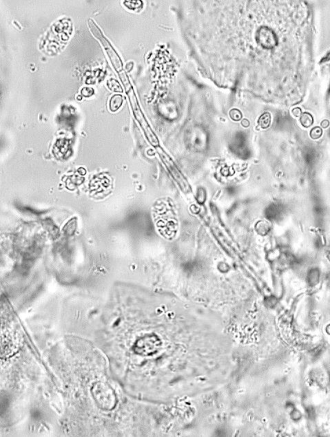 Candidiasis Curriculum Diagnosis PMNs and Yeast Pseudohyphae Saline: 40X objective Yeast pseudohyphae PMNs