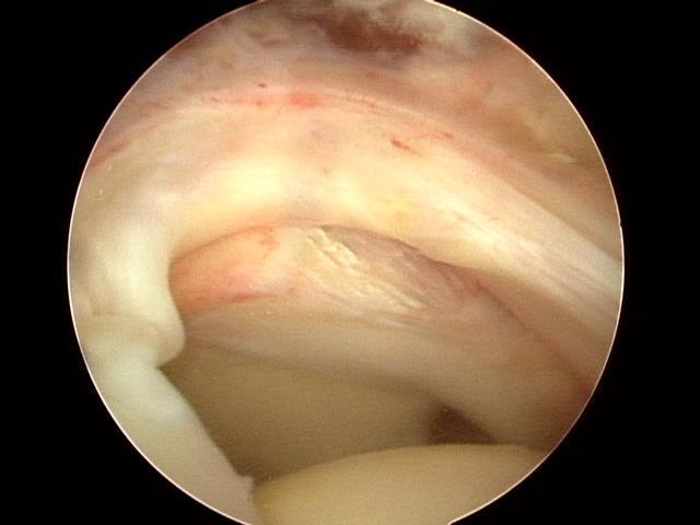 ARTHROSCOPIC Allows visualization of articular surface and Bursal surface of cuff Able to