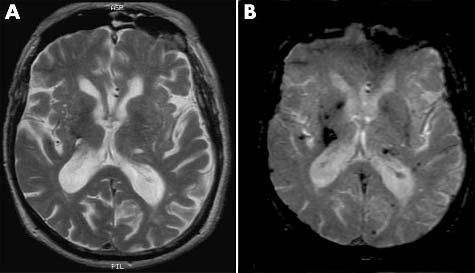 Structural magnetic resonance neuroimaging 1237 Clinical environment N Acute cerebral haemorrhage Reliable identification of acute haemorrhage is important for differentiation between a haemorrhagic