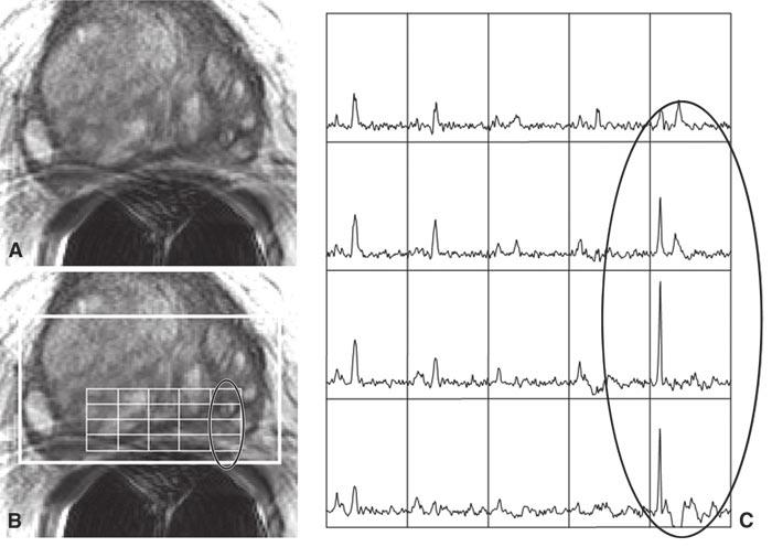 Prostate MRI and 3D MR Spectroscopy Several approaches have been used to display the combination of anatomic and metabolic information derived from simultaneous MRI and MRSI.